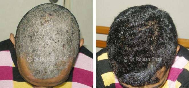 Psoriasis Before and After Case Photo