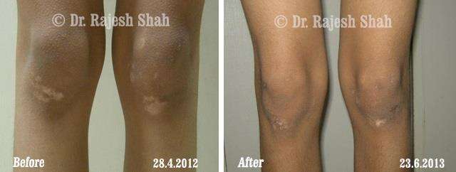 Vitiligo Before and After Case Photo