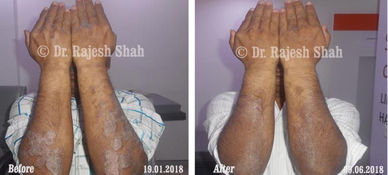 Psoriasis Before and After Case Photo