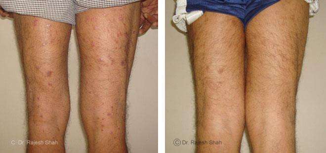 Psoriasis Before and After Case Photo