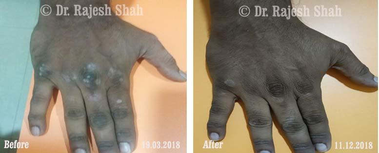 Psoriasis Before and After Case Photo