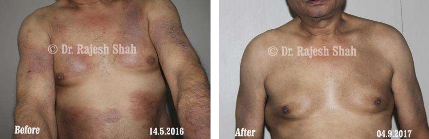 Atopic Dermatitis Before and After Case Photo