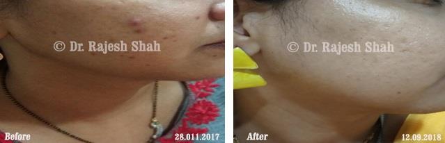 Acne Before and After Case Photo