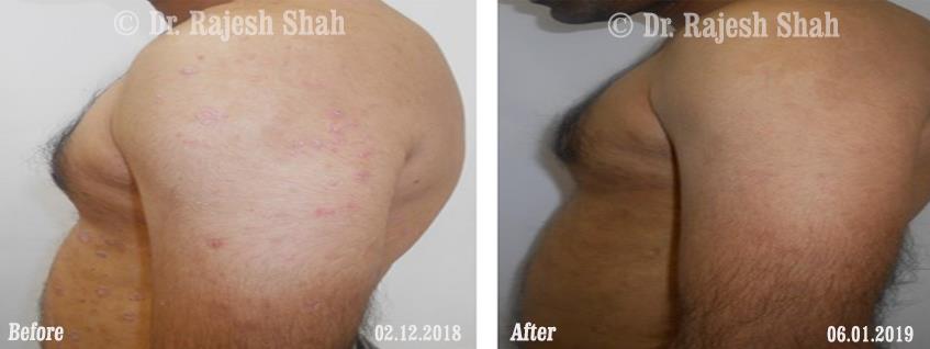 Psoriasis Before and After Case Photo