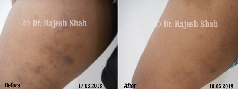 Alopecia Areata Before and After Case Photo