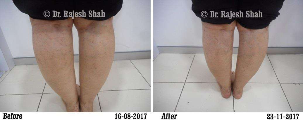 Lichen Planus Before and After Case Photo