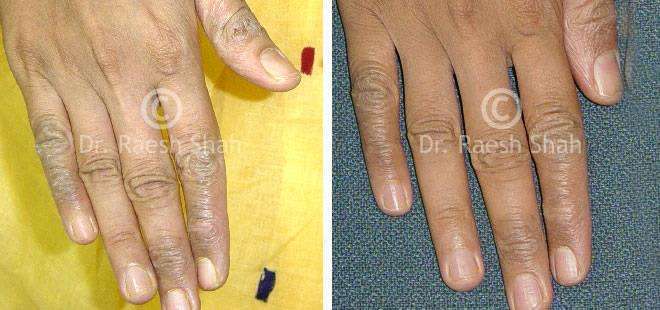 Eczema Before and After Case Photo