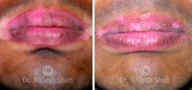 Vitiligo Before and After Case Photo