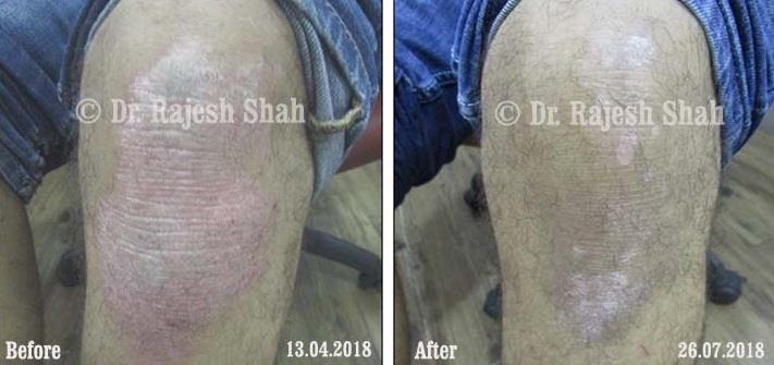 Psoriasis Before and After Case Photo