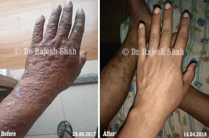 Psoriasis Before and After Case Photo