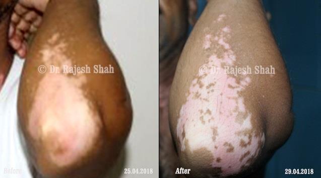 Vitiligo Before and After Case Photo