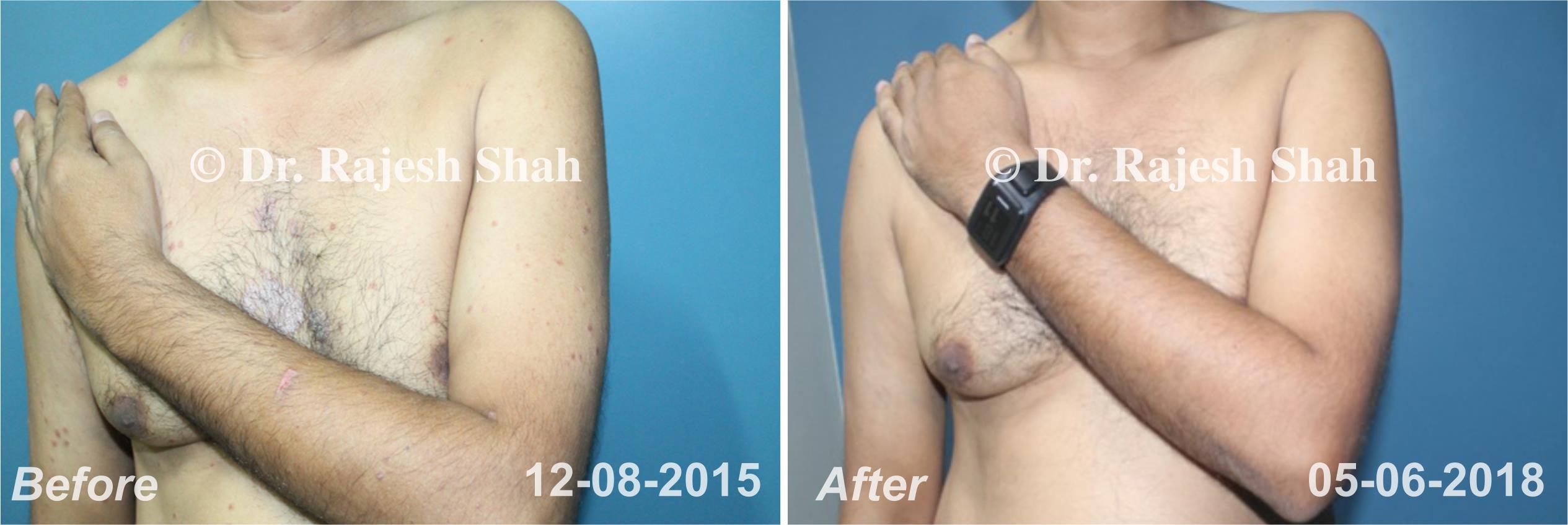 Psoriasis Before and After Case Photo