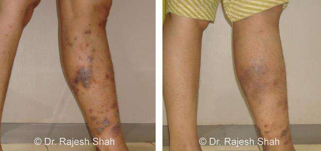 Psoriasis Before and After Case Photo