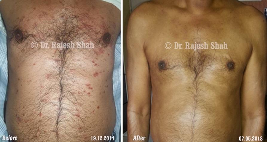 Psoriasis Before and After Case Photo