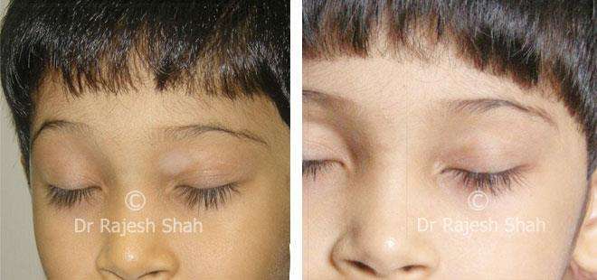 Vitiligo Before and After Case Photo