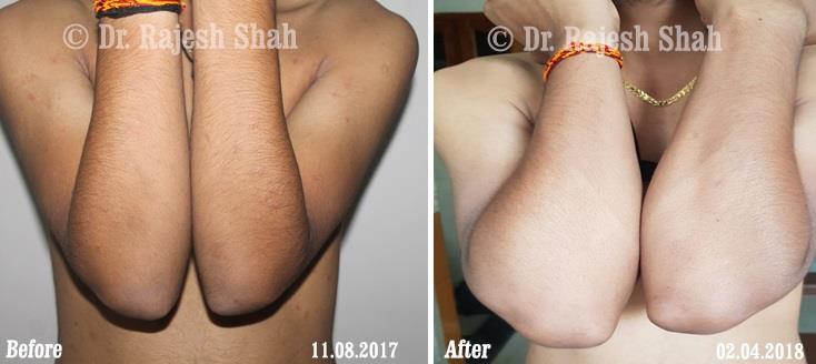 Lichen Planus Before and After Case Photo