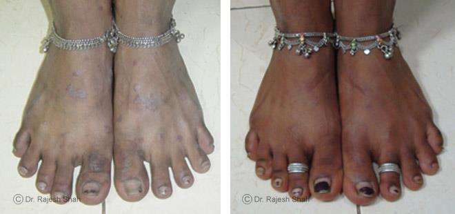 Psoriasis Before and After Case Photo