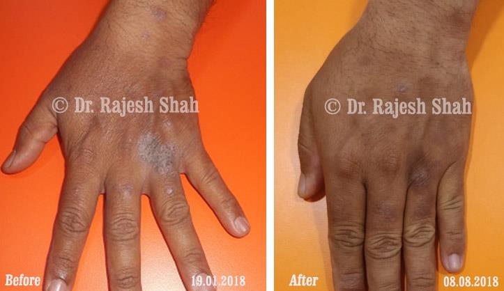 Psoriasis Before and After Case Photo