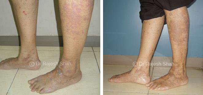 Lichen Planus Before and After Case Photo