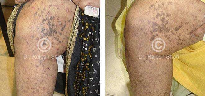 Lichen Planus Before and After Case Photo