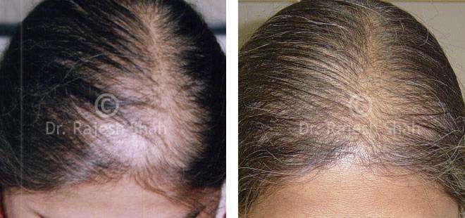 Alopecia Areata Before and After Case Photo