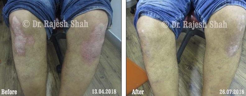 Psoriasis Before and After Case Photo