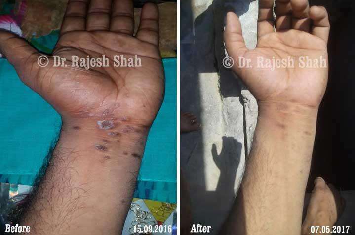 Lichen Planus Before and After Case Photo