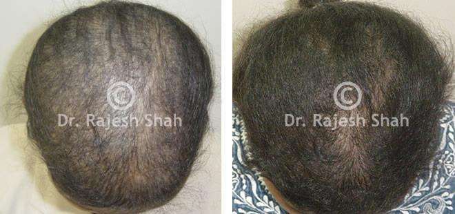 Alopecia Areata