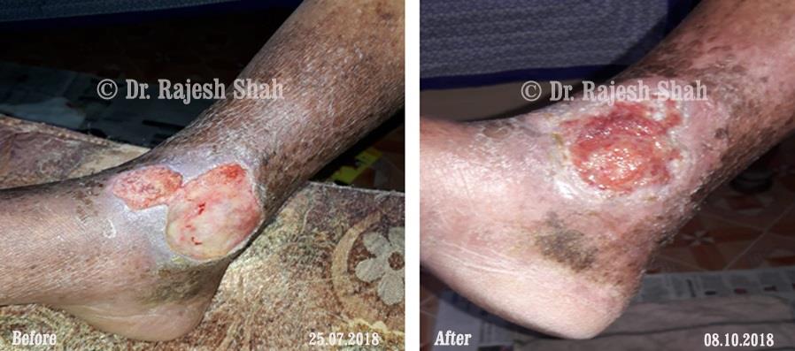 Non-healing ulcers Before and After Case Photo