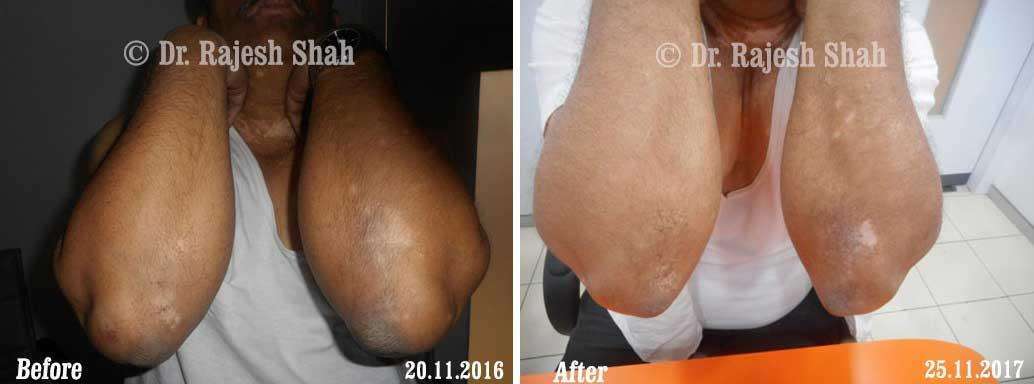 Vitiligo Before and After Case Photo