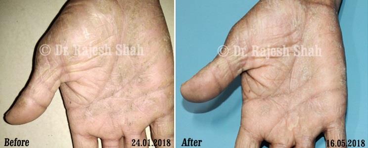 Atopic Dermatitis Before and After Case Photo