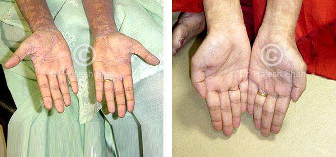 Lichen Planus Before and After Case Photo