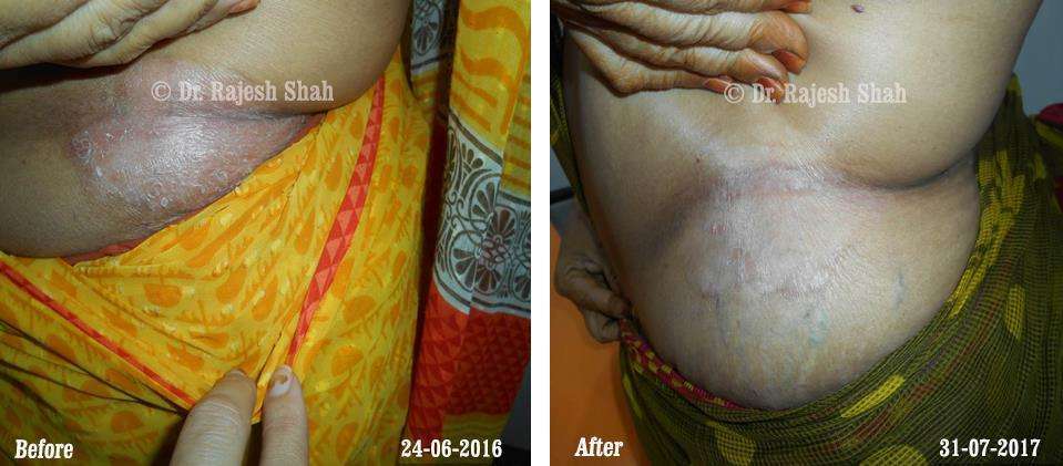 Psoriasis Before and After Case Photo