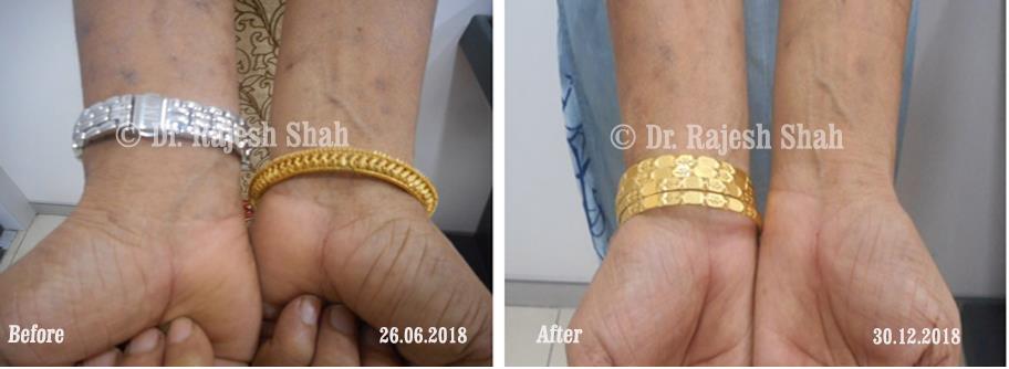 Lichen Planus Before and After Case Photo