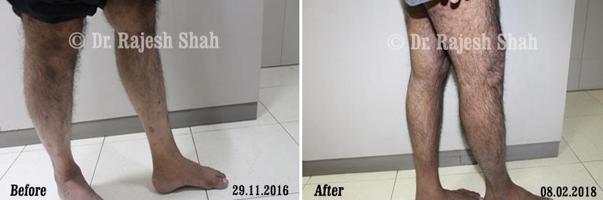 Psoriasis Before and After Case Photo