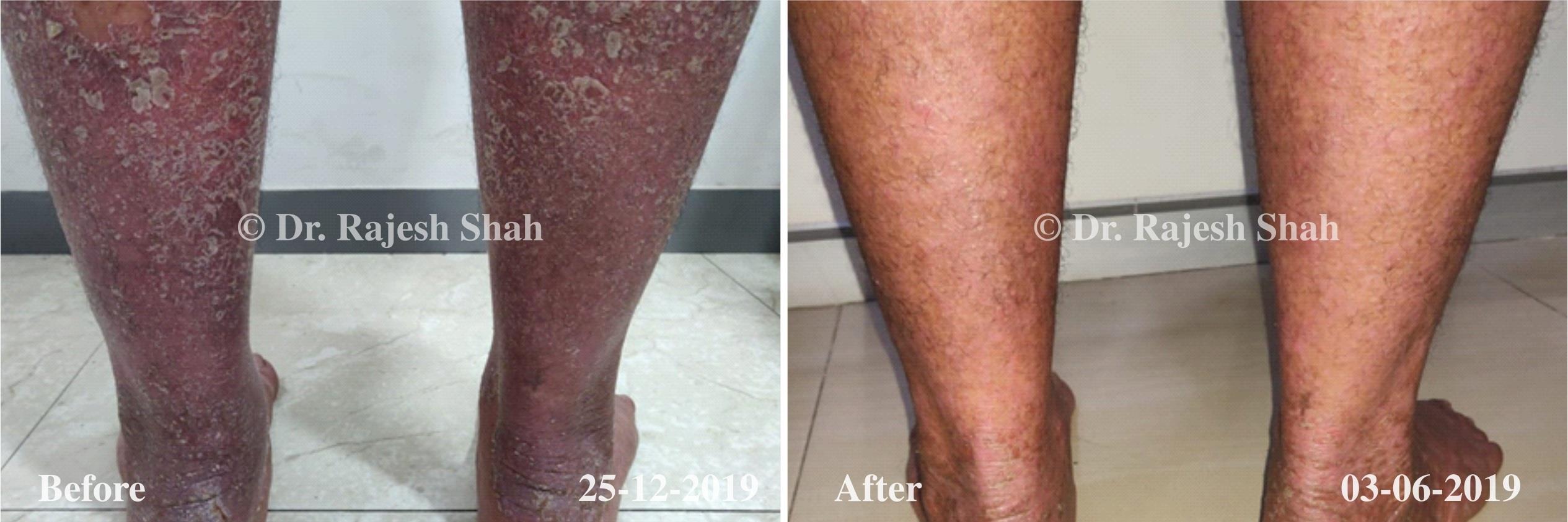Psoriasis Before and After Case Photo