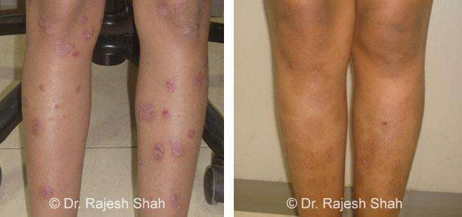 Psoriasis Before and After Case Photo