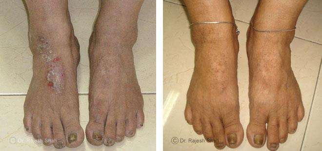 Eczema Before and After Case Photo