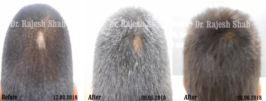 Alopecia Areata Before and After Case Photo