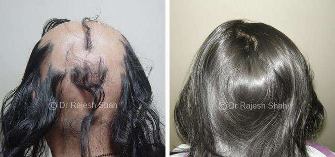 Alopecia Areata Before and After Case Photo