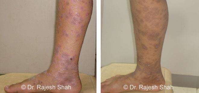 Lichen Planus Before and After Case Photo