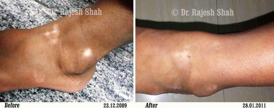 Vitiligo Before and After Case Photo