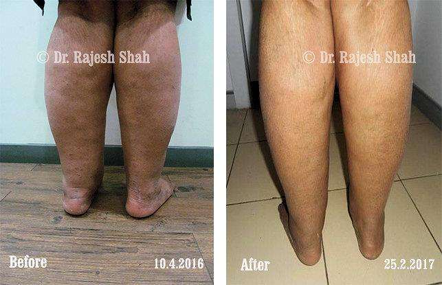 Lichen Planus Before and After Case Photo