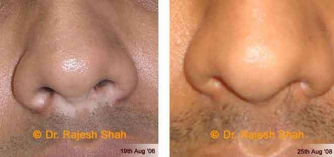 Vitiligo Before and After Case Photo