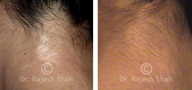 Vitiligo Before and After Case Photo
