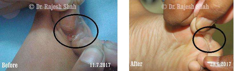 Eczema Before and After Case Photo