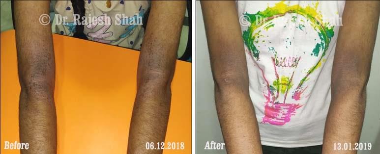 Atopic Dermatitis Before and After Case Photo