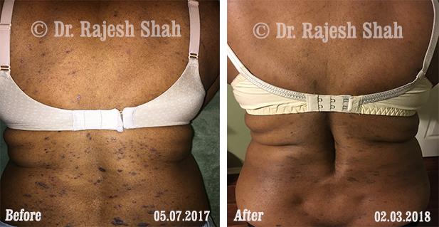 Lichen Planus Before and After Case Photo