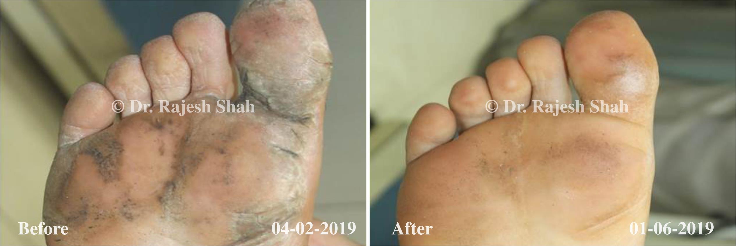 Psoriasis Before and After Case Photo