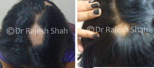 Alopecia Areata Before and After Case Photo